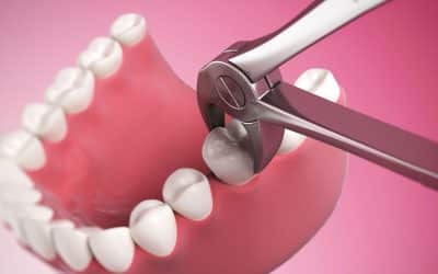 5 Reasons for Tooth Extractions