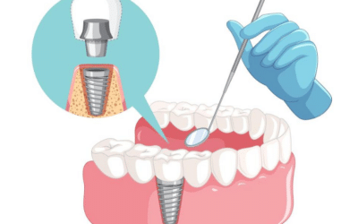 What To Eat After Dental Implant Surgery 