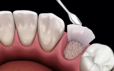 What are the Different Types of Bone Grafts & Their Benefits To a Patient?