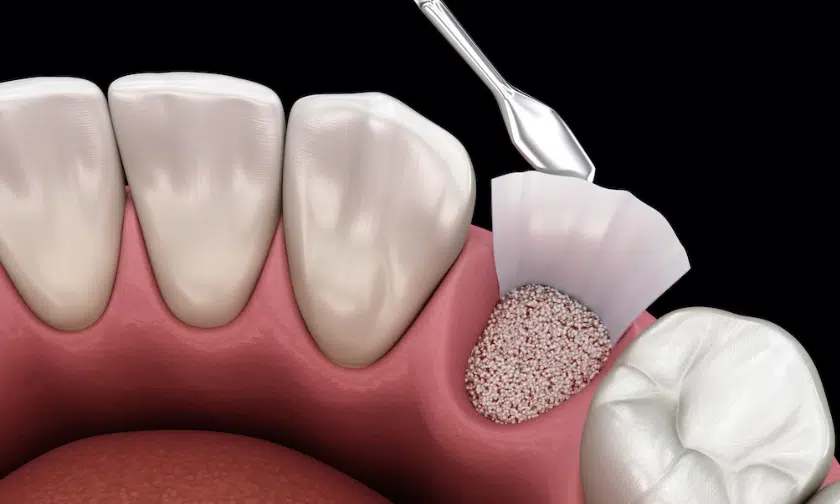 Dental Implant Bone Graft  Bone Grafting for Dental Implant