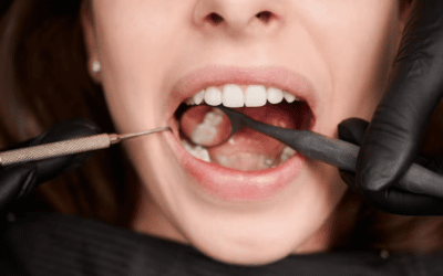 Preparing For Gum Graft Surgery: A Step-By-Step Guide￼