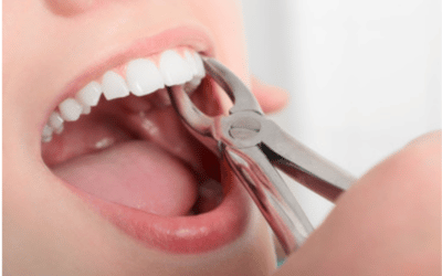 Everything You Need To Know About Healing After A Tooth Extraction