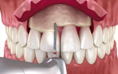 A Comprehensive Guide on Crown Lengthening and Its Benefits