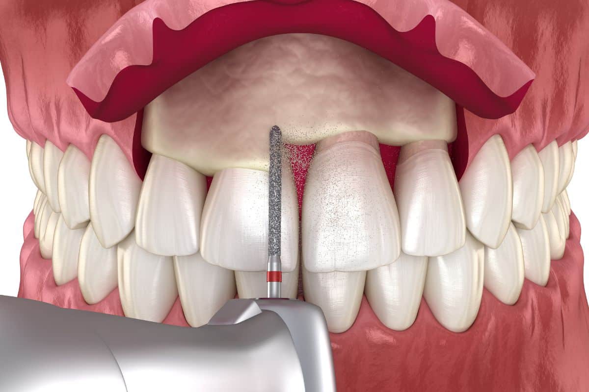 A Comprehensive Guide on Crown Lengthening and Its Benefits