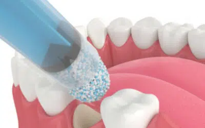 What to Expect After a Dental Bone Graft Procedure?