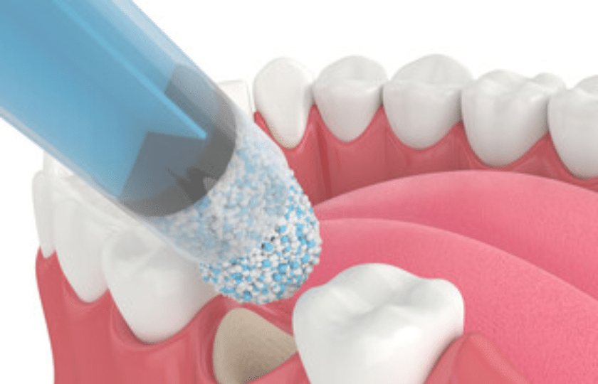 Dental Bone Graft