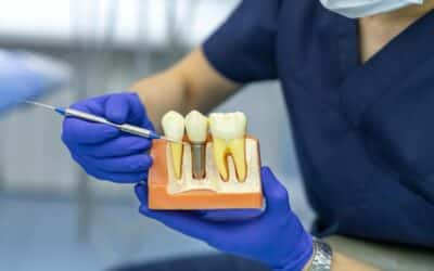 How To Take Care Of Your Dental Implants