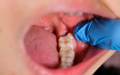 Pinhole Surgery To Treat Gum Recession In Phoenix