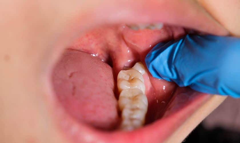 Gum Recession in Phoenix Pinhole Surgery To Treat Gum Recession In Phoenix