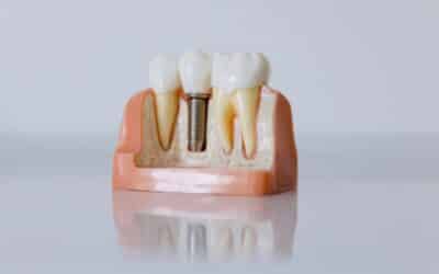 Is It Possible To Have Dental Implants In Just One Day