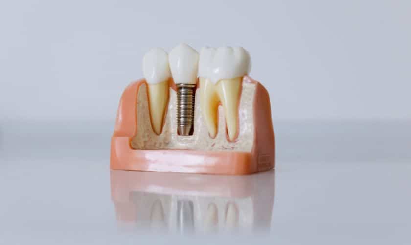 Is It Possible To Have Dental Implants In Just One Day