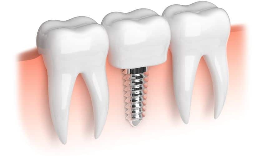 Dental Implant in Phoenix