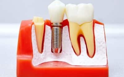 Dental Implants in Phoenix: A Long-Term Replacement for Missing Teeth