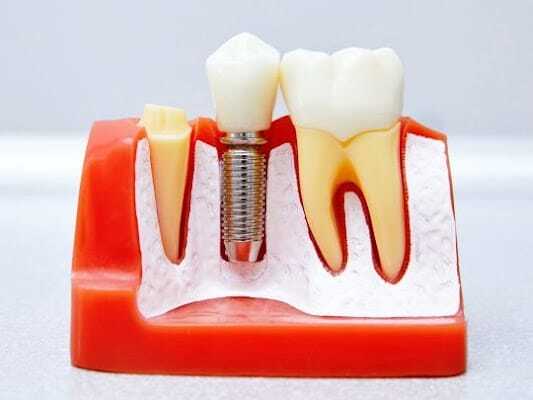 Dental Implant in Phoenix