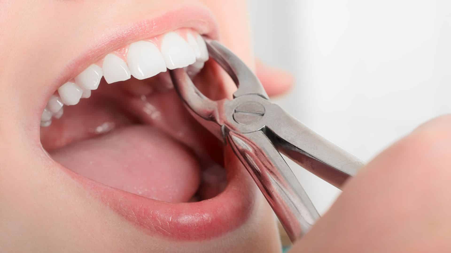 Tooth Extractions