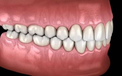 What is Occlusal Therapy and Why is it Important?