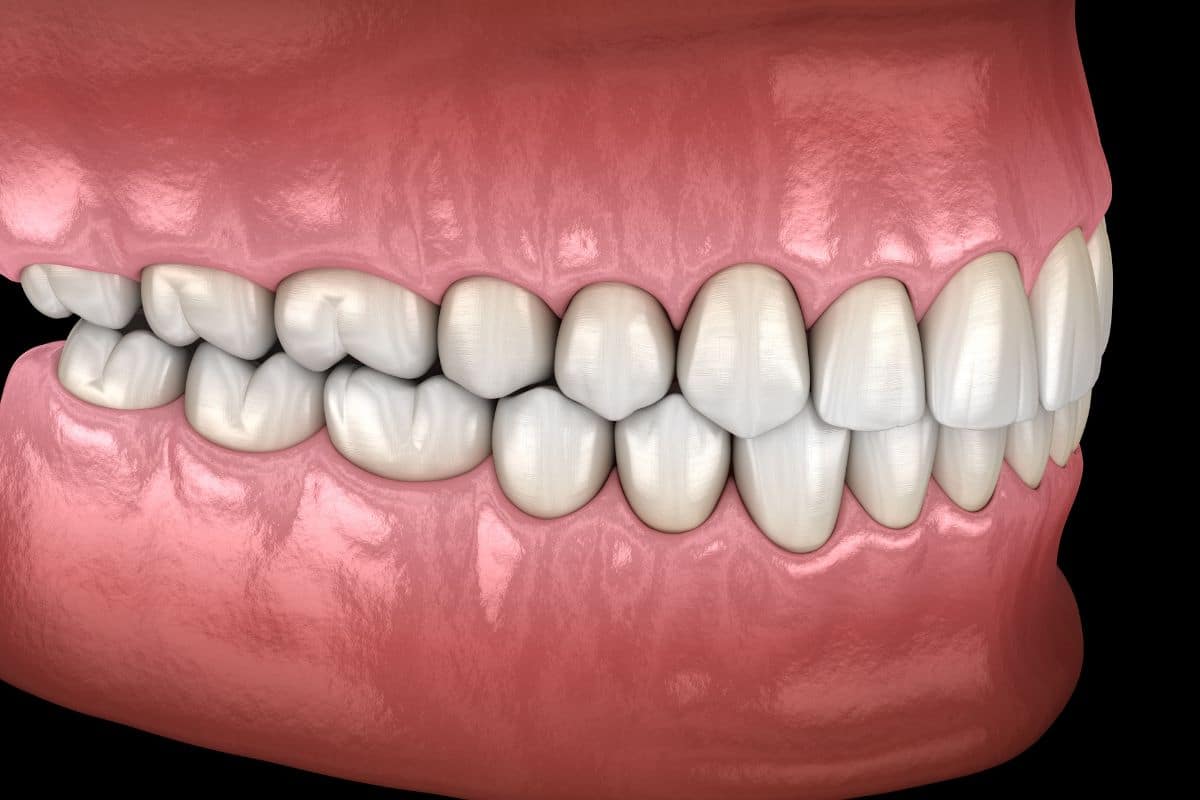 What is Occlusal Therapy and Why is it Important?