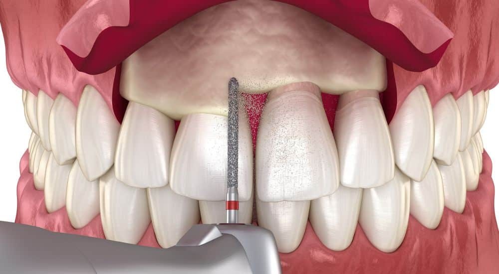 Concepts and Considerations for Surgical Crown Lengthening