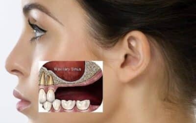 Important Things to Know About Sinus Grafting
