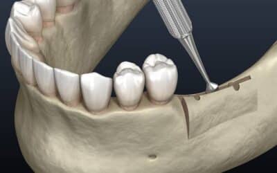 Ridge Augmentation: A Prerequisite for Successful Implant Placement