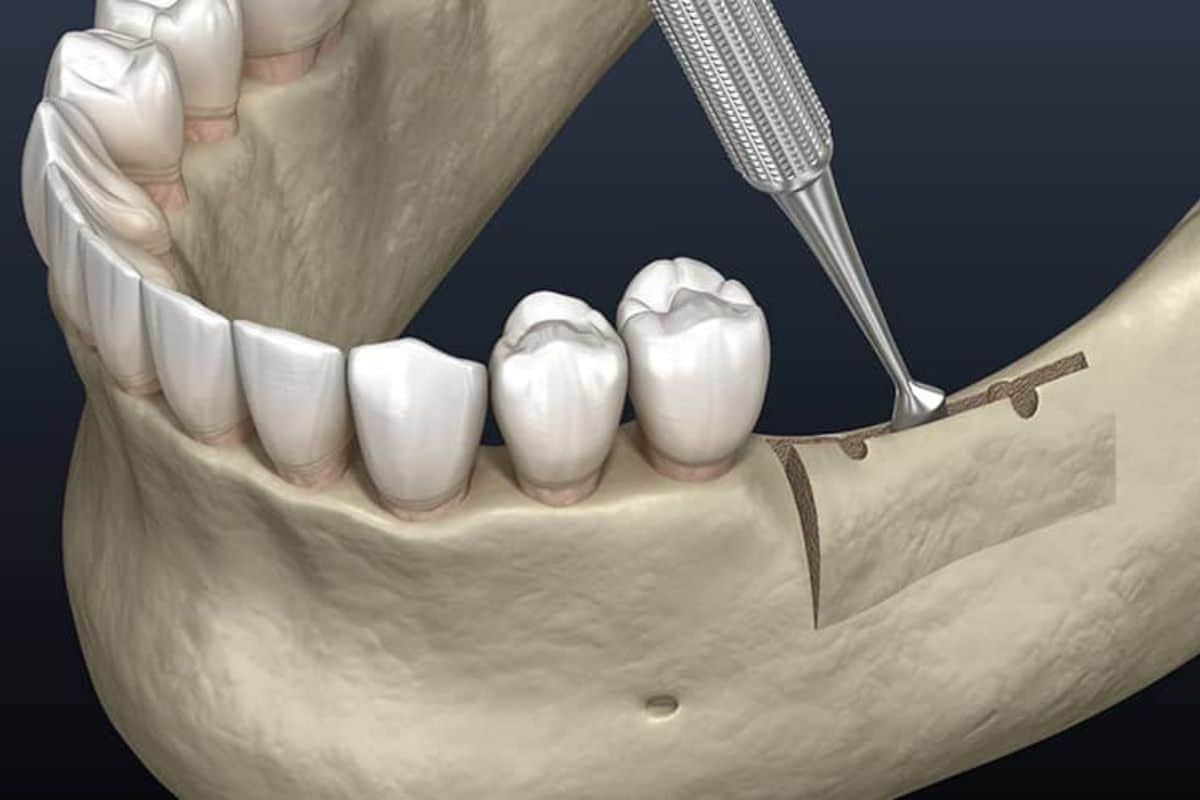 Ridge Augmentation Is a Prerequisite for Successful Implant Placement