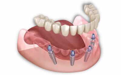 Teeth in a Day: A Myth or Reality? How the Dental Implant Process Works