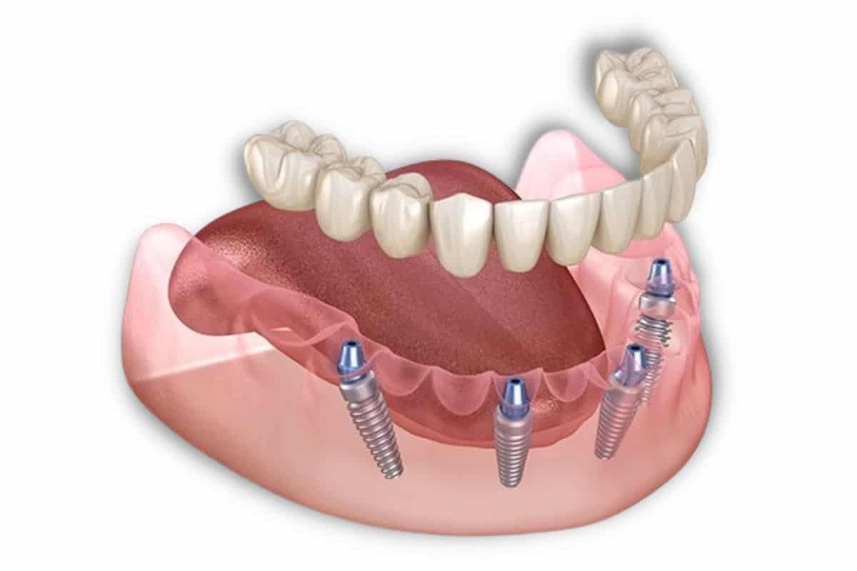 Teeth in a Day: A Myth or Reality