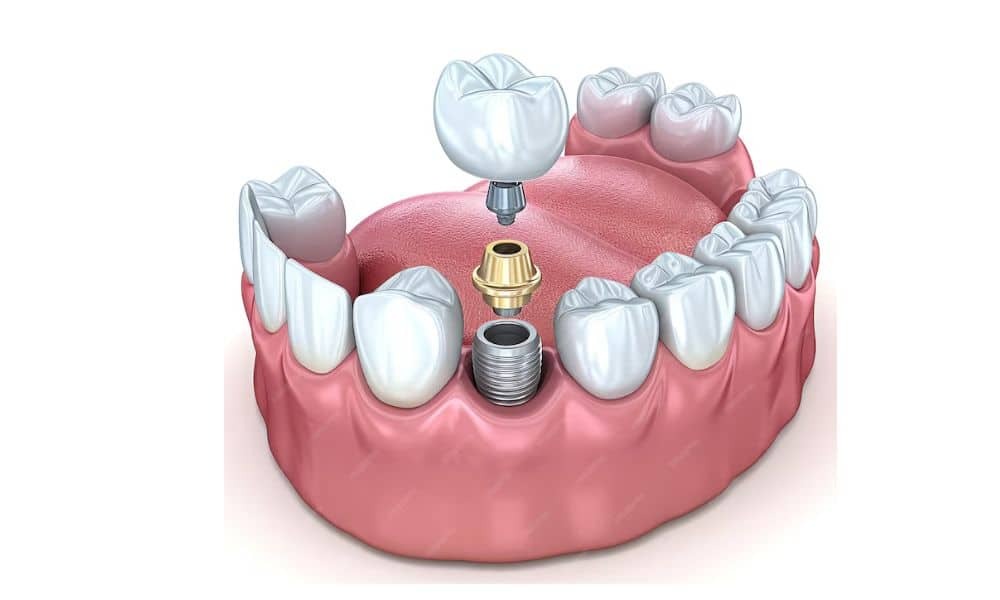 Different Types of Dental Implants