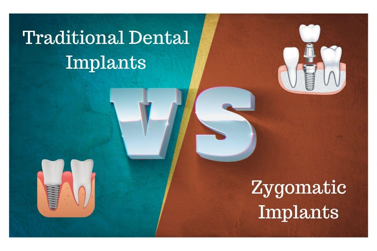 Traditional Dental and Zygomatic Implants