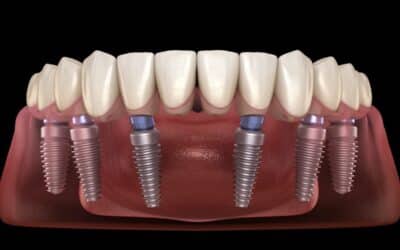 Top 8 Factors to Consider Before Getting All-on-4 Dental Implants