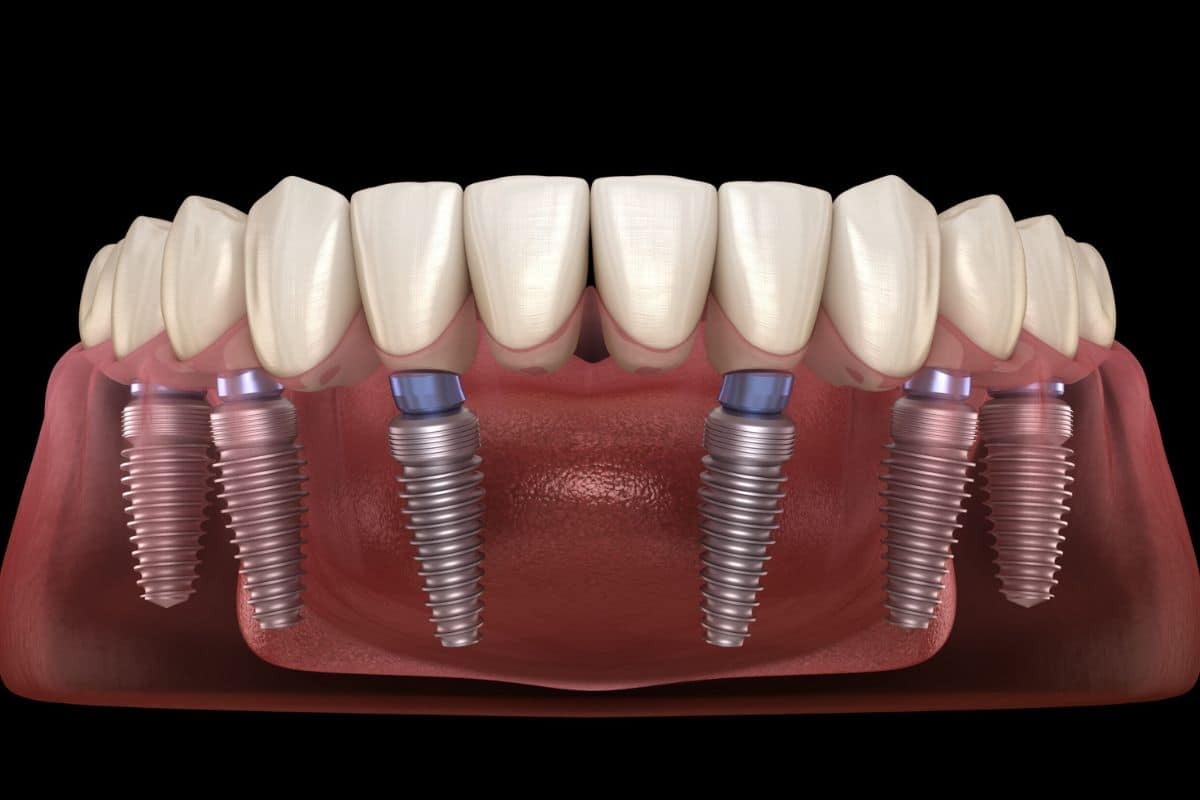 Top 8 Factors to Consider Before Getting All-on-4 Dental Implants