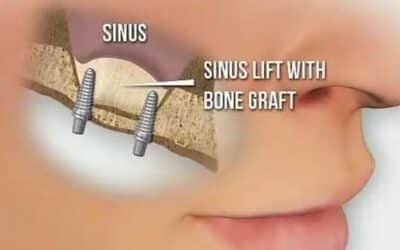 How Sinus Grafting Helps Restore Bone Structure for Implants