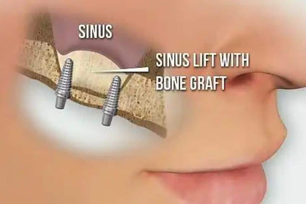 Sinus Grafting