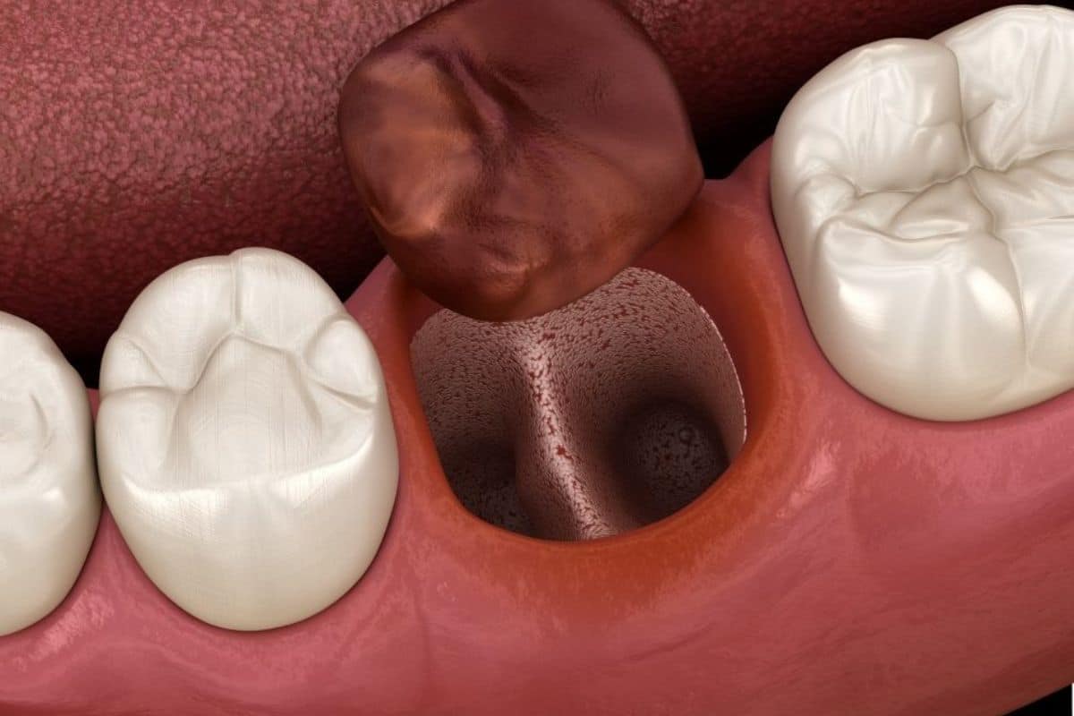 How to Treat Dry Sockets A Comprehensive Guide How to Treat Dry Sockets: A Comprehensive Guide