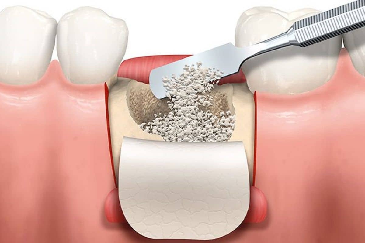 Types of Bone Grafts Used in Oral Surgery