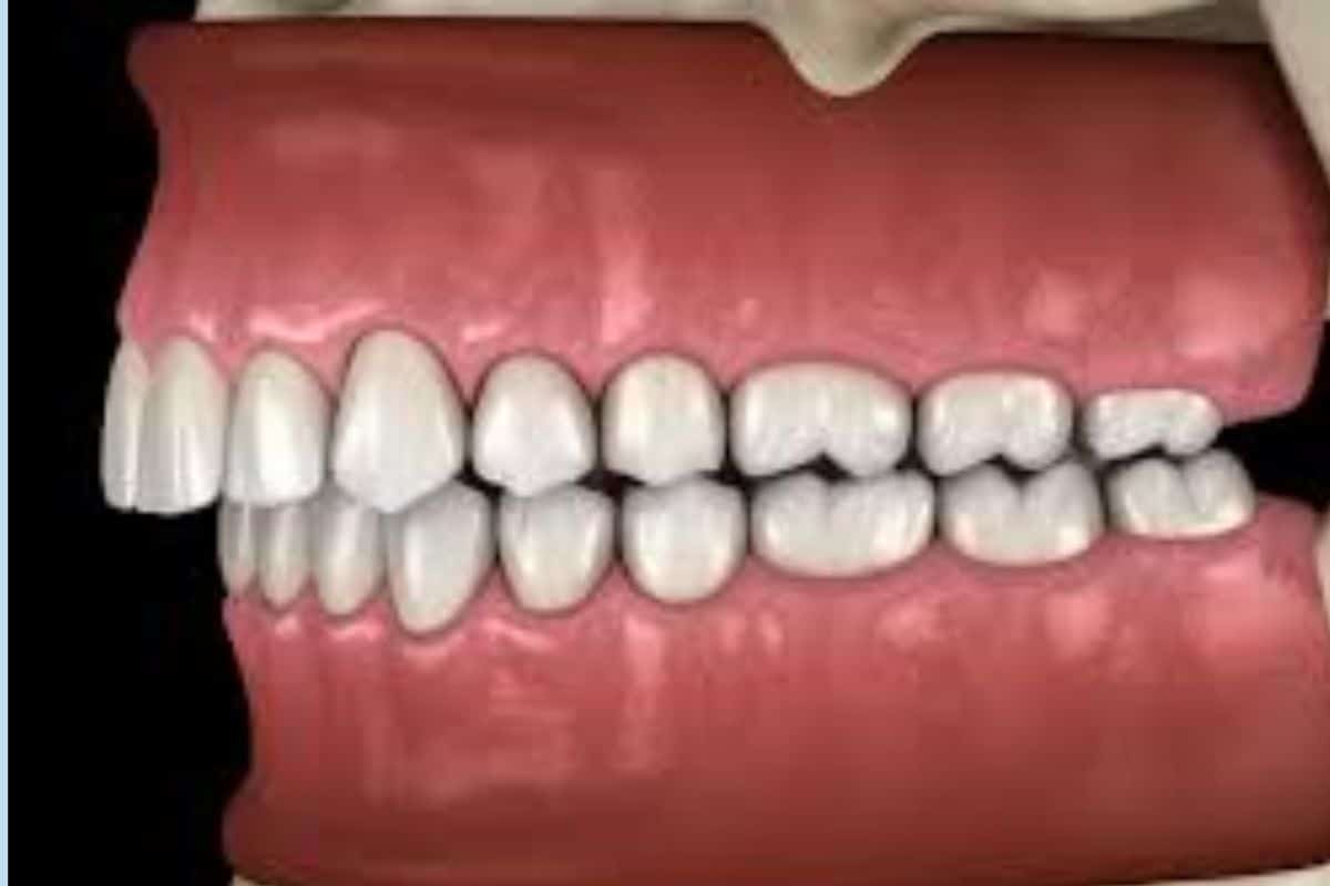 How an Anterior Bite Plane Helps Correct Malocclusions How an Anterior Bite Plane Helps Correct Malocclusions