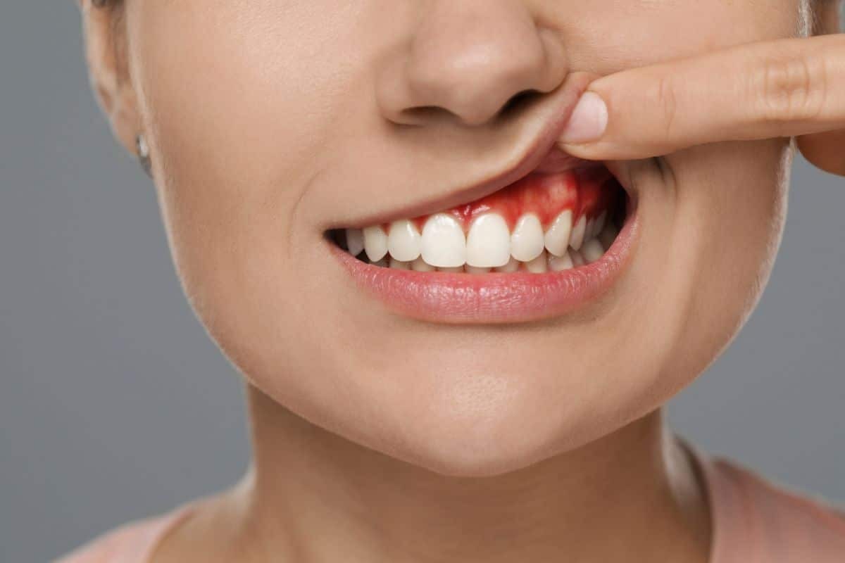 Periodontal Disease