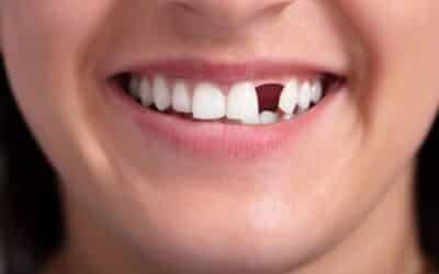 What to Do If You Lose a Front Tooth: Immediate Steps to Take