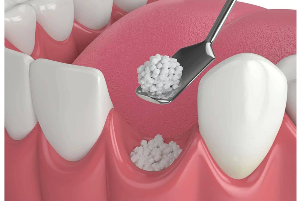 Bone Graft Before Getting Dental Implants