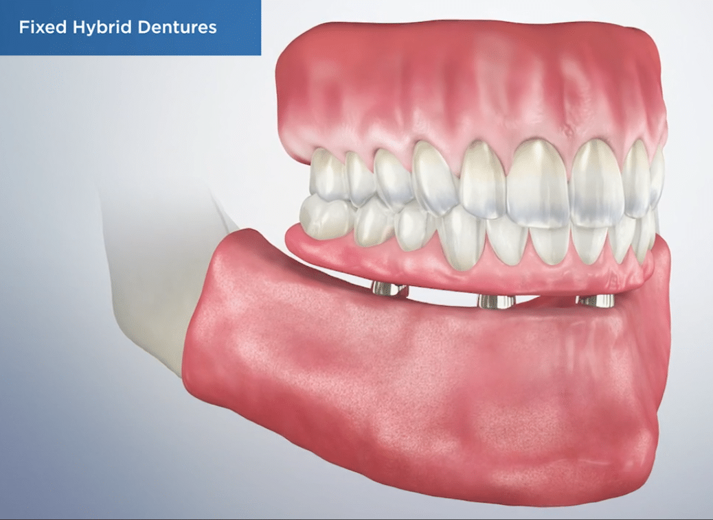 Recovery with Fixed Hybrid Dentures