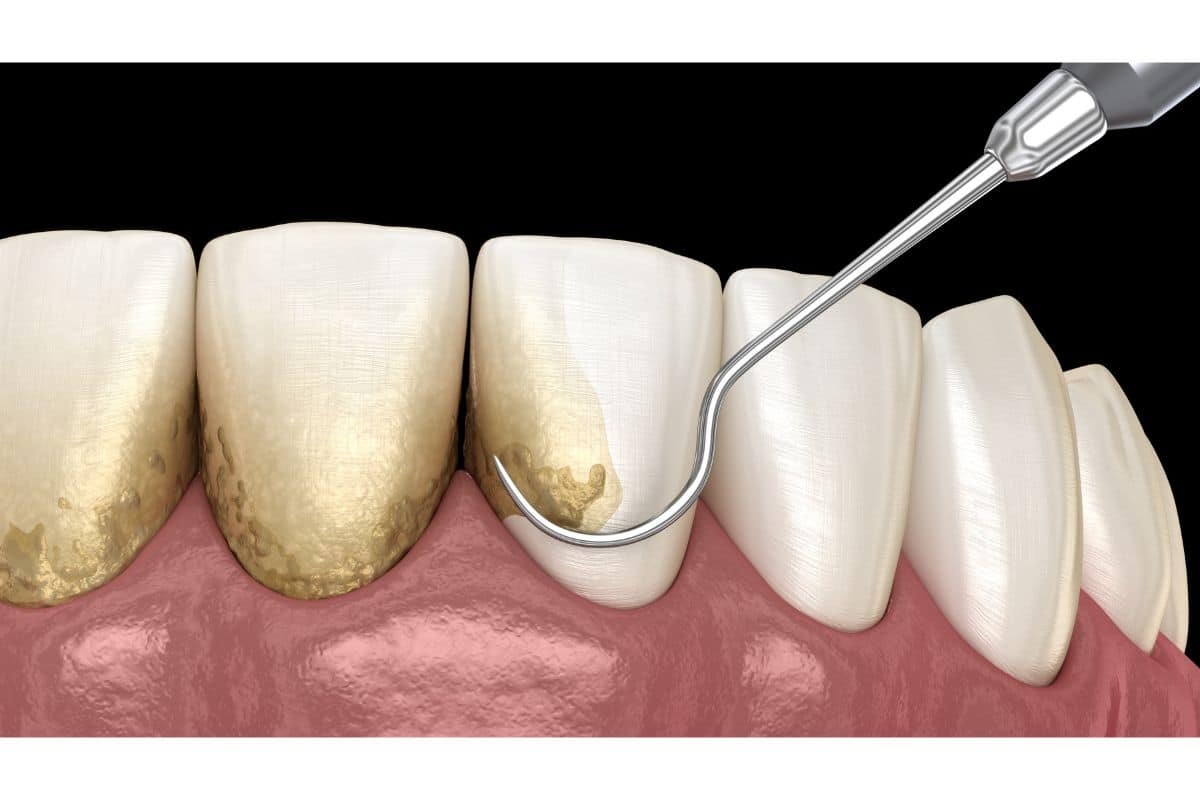 How Often Do You Need Scaling and Root Planing for Healthy Gums