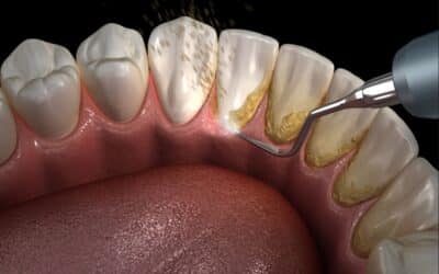 How Poor Oral Hygiene Leads to Plaque and Tartar (Calculus) Buildup