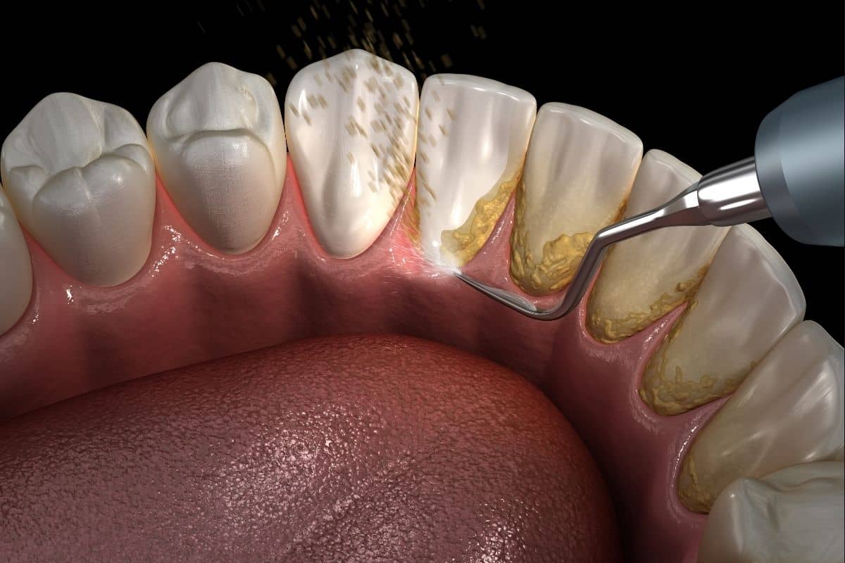 Poor Oral Hygiene Leads to Plaque and Calculus Buildup