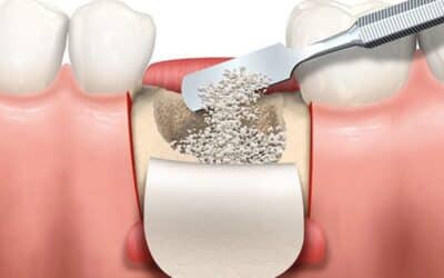 Bone Graft Recovery Tips: How to Heal Faster and More Comfortably