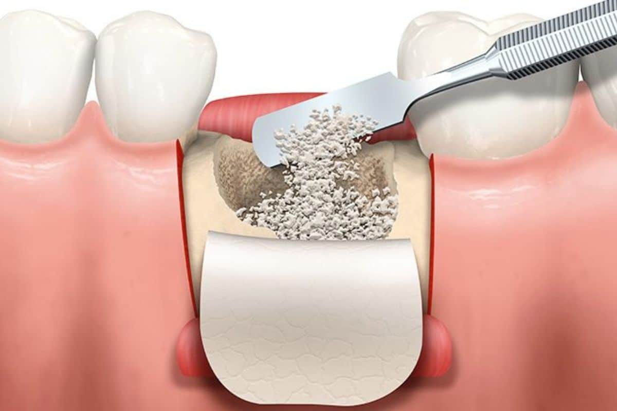 Bone Graft