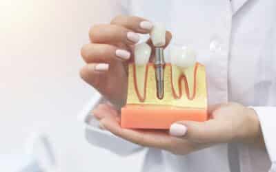 Book Your Consultation for Anterior Implants and Healing Cap Placement