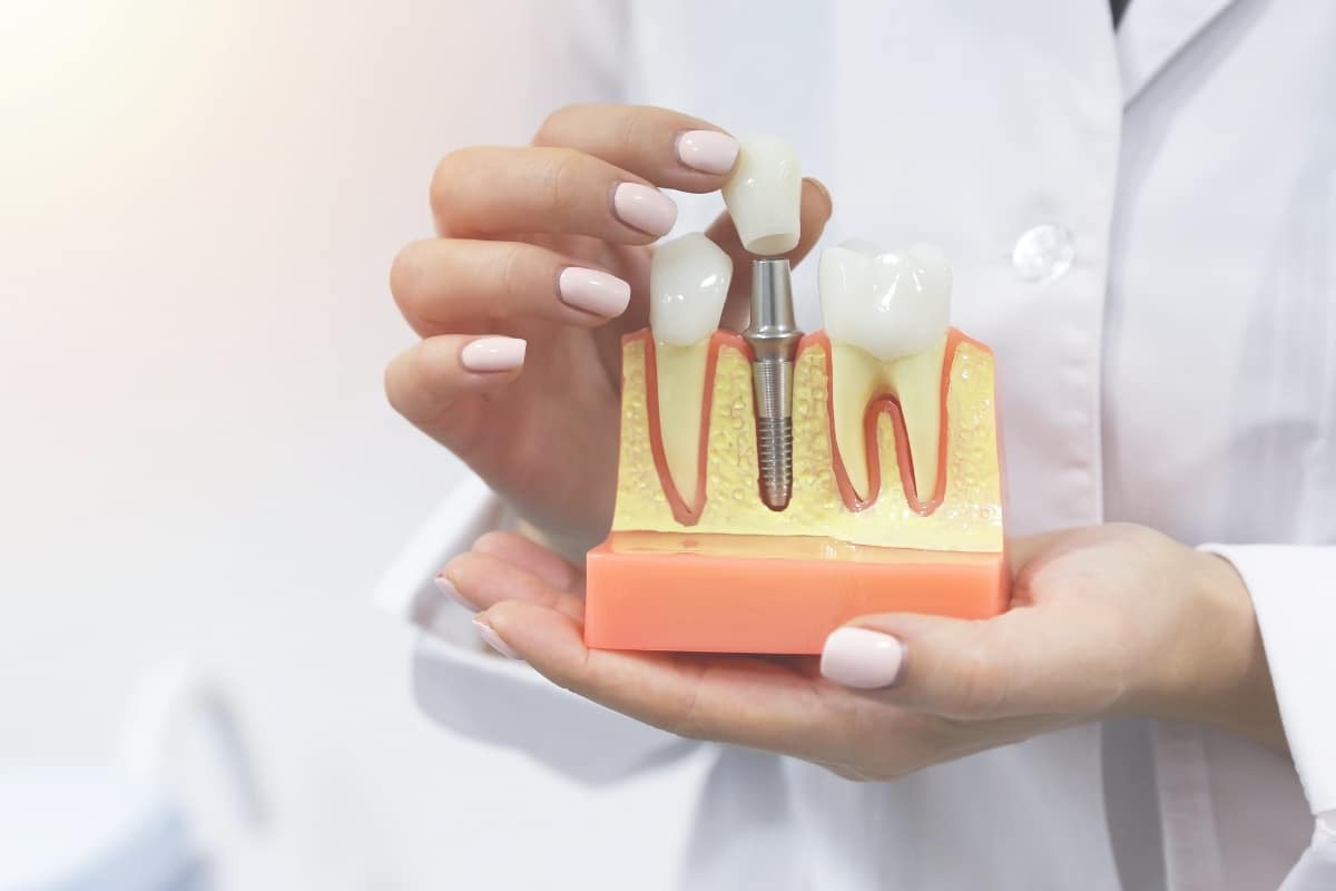 Book Your Consultation for Anterior Implants and Healing Cap Placement Anterior Dental Implants Consultation