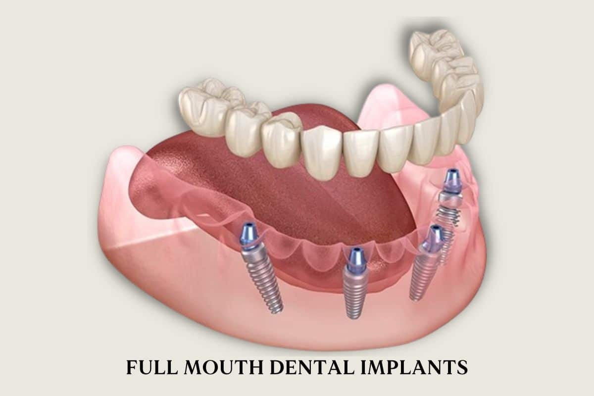 Removable Full Arch dental Implants