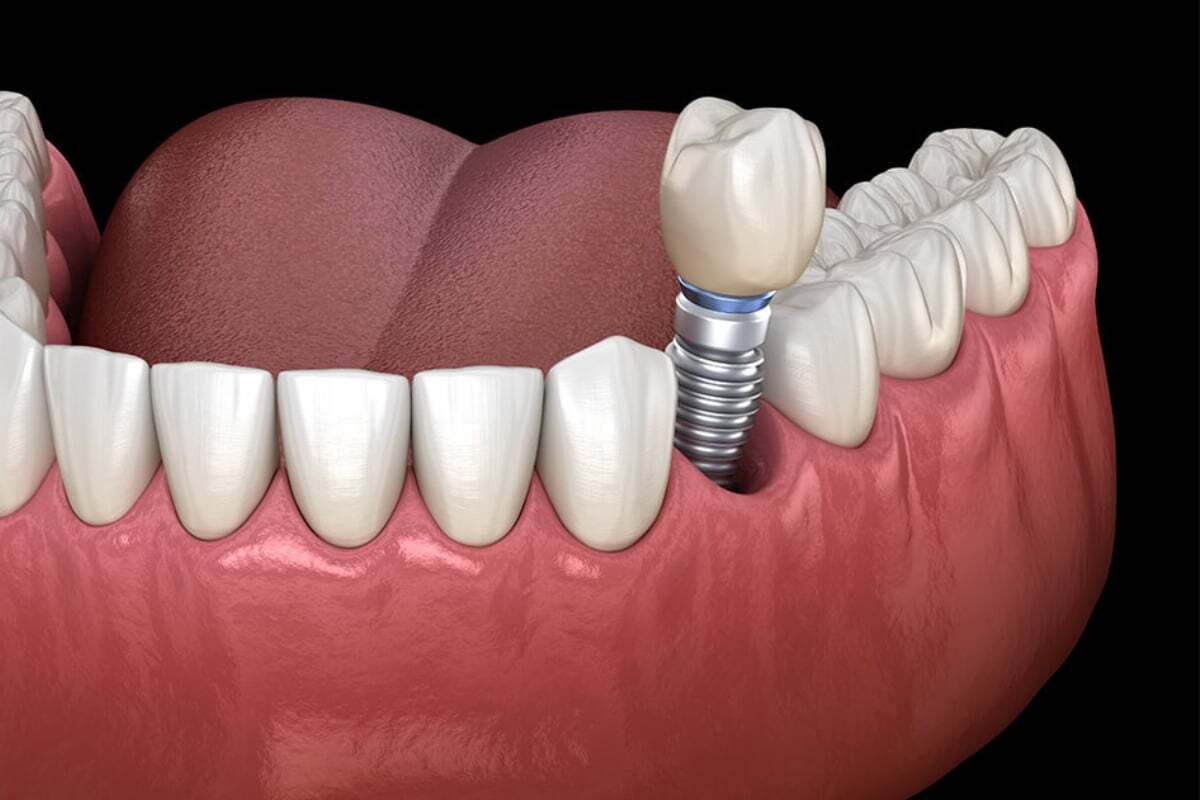 Bone Graft with Implant Placement vs. Bone Graft without Implant