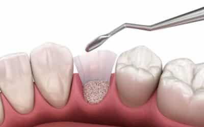 Bone Grafting Recovery: Timeline, Healing & What to Expect